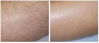 Vectus Leg Hair